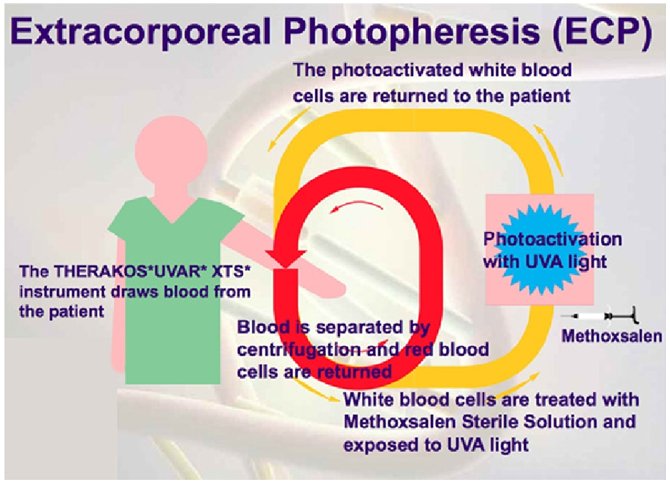 extracorporeal photopheresis